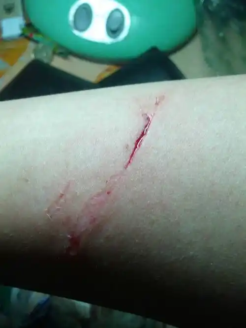 问:好心人,帮我看看,我得伤口用不用打破伤风疫苗