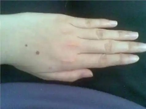 手背有痣的手相男子注定富裕女子一生富贵