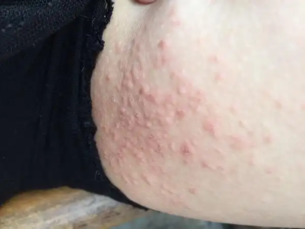 大腿两侧红疙瘩,还会痒,这是什么东西?
