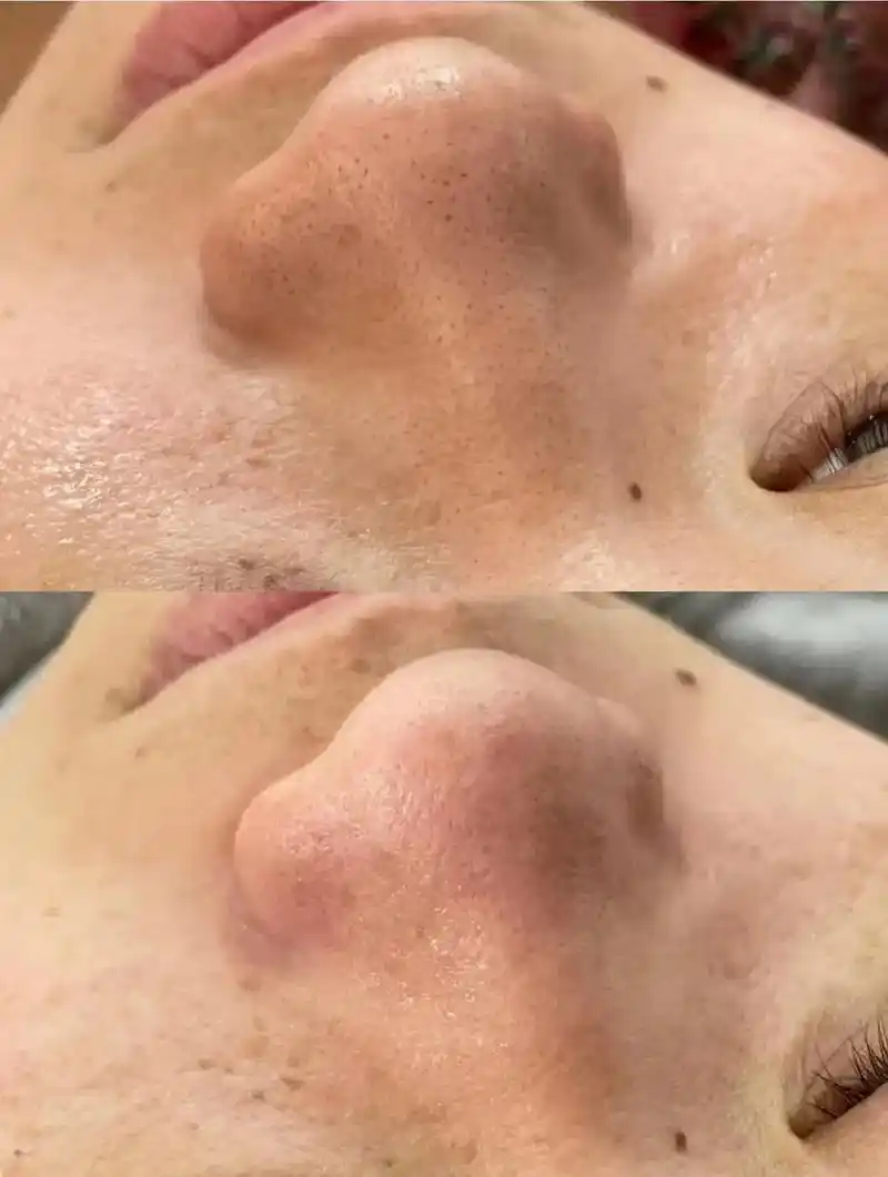 毛孔黑头清洁前后对比vs一请不要忽路.