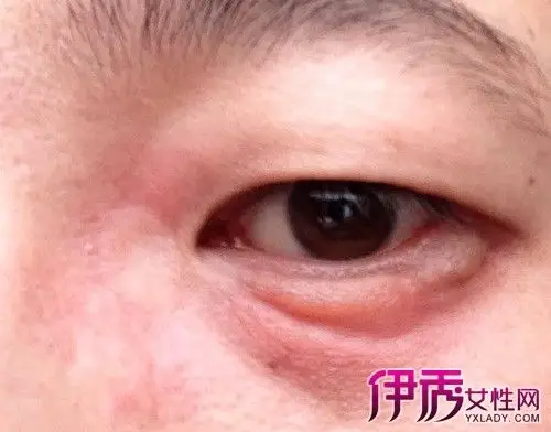 【图】我的下眼皮肿是怎么回事啊 多种方法轻松解决该症状