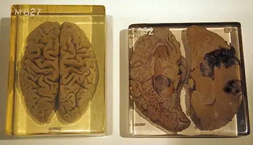 直击最另类的"文物":爱因斯坦的大脑被切成240片展出