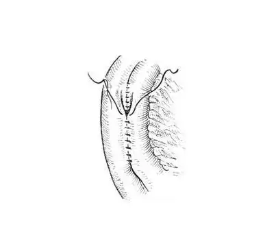 小肠侧侧吻合术过程图-手术图解