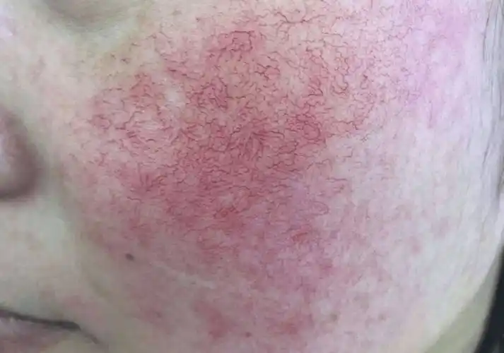 皮肤受损50℅,是呈线状的红血丝;当皮肤受损30℅,是呈点状的红血丝