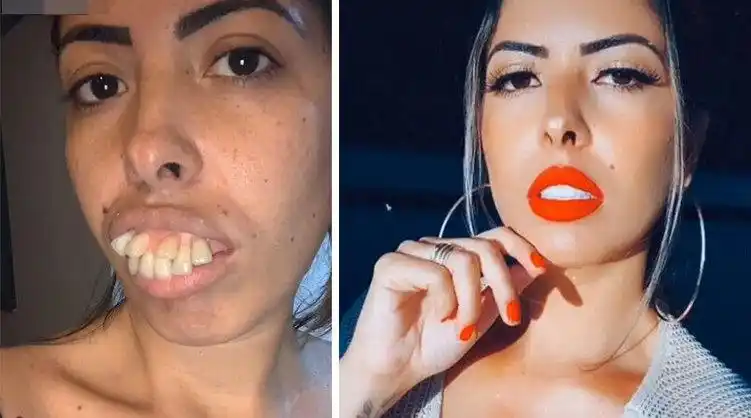 女子发布牙齿整形前后对比视频爆红被网友质疑后承认戴假牙