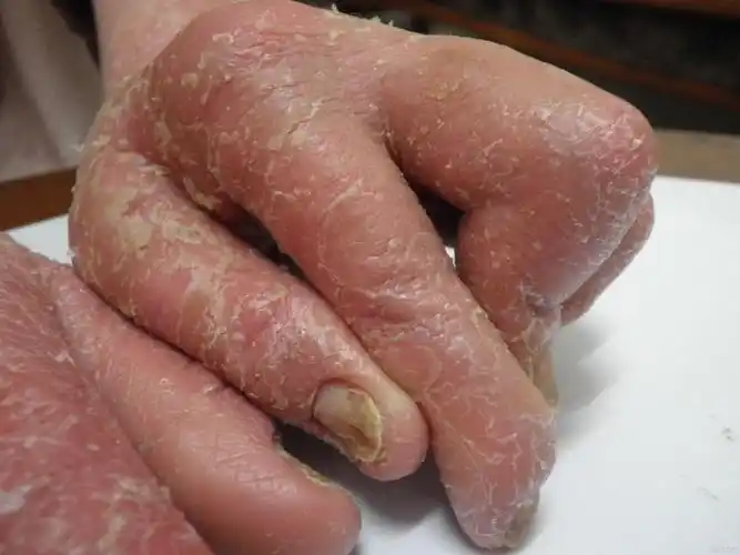 关节病型银屑病