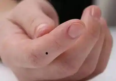 手掌痣小腿的痣代表刻苦耐劳,有责任心,能照顾家庭.