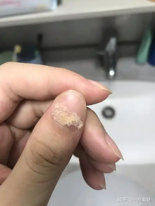 见过的最大头皮屑多大? - 知乎