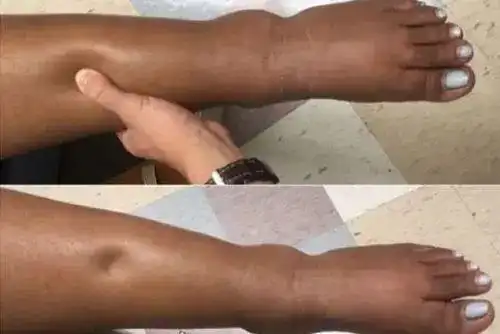 远离尿毒症,从学习肾脏疾病的自我监察开始|血尿|水肿|尿常规_网易