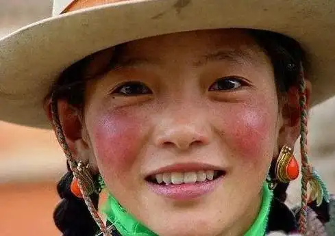 比方说藏族同胞的高原红,就是由于长期紫外线暴晒后造成的角质偏薄