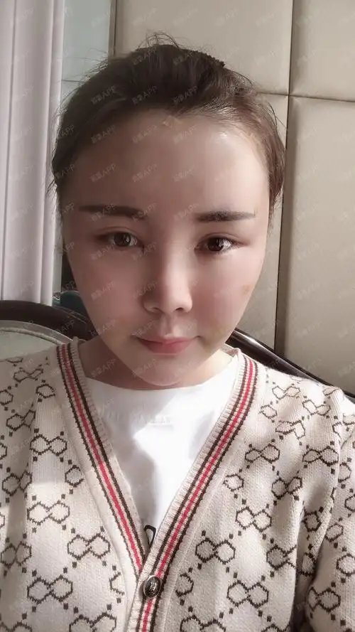 【脂肪填充饱满童颜术后7天】