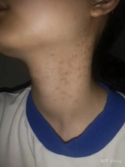 马拉色菌毛囊炎的治疗史