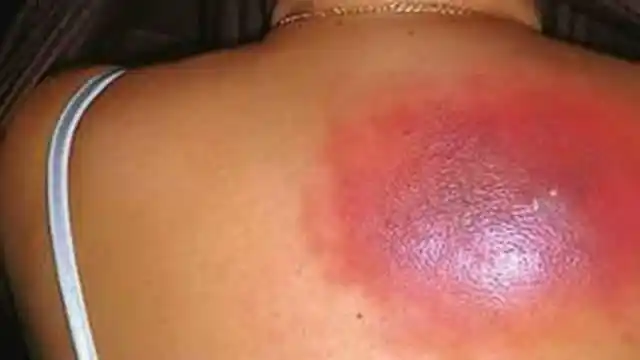 背上长了这种疮一不小心就会痛死到底是什么