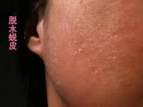 脸上角质层过薄如何增厚角质层