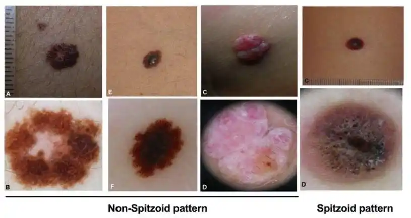 52例儿童和青少年黑色素瘤临床及皮肤镜特点的多中心研究