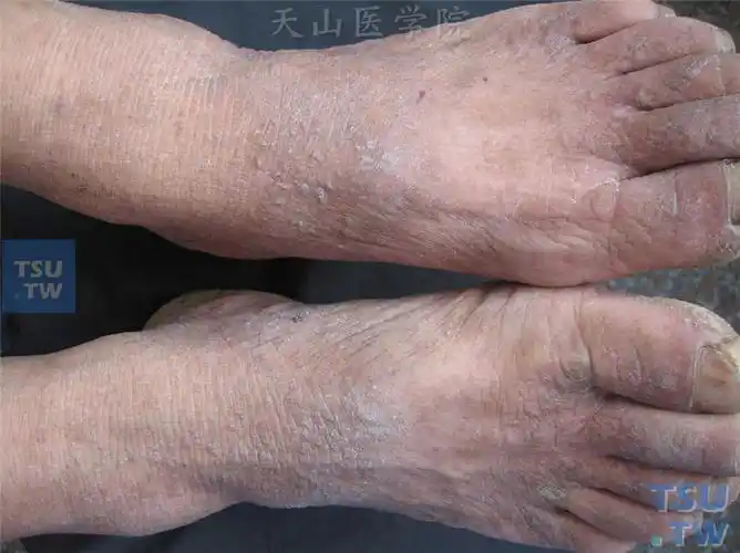 毛囊角化症(darier病)症状表现