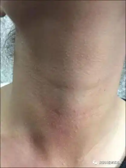 脖子长了鸡皮疙瘩?可能是播散性复发性漏斗部毛囊炎