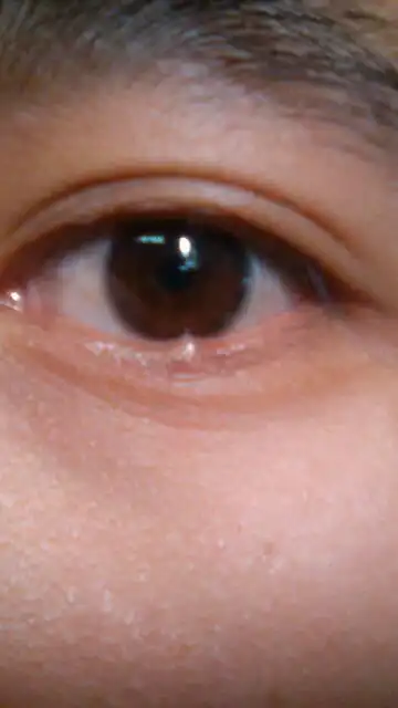 健康咨询描述:                      下眼皮长了个痘子还是什么 一个