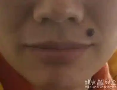 脸上的痣有长毛,能不能拔的啊!