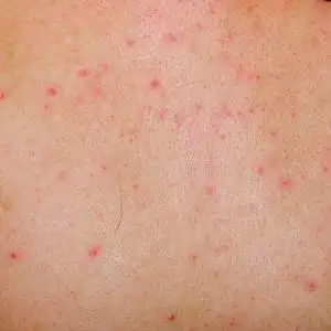 过敏性皮疹皮炎湿疹皮肤,皮肤疾病的女性患者过敏性皮疹皮炎过敏性