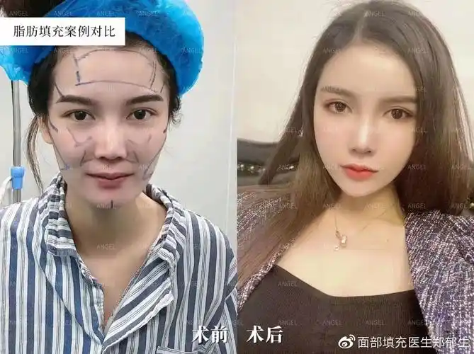 案例告诉你脂肪胶和自体脂肪区别是啥填充面部安全吗