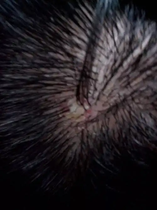 头发根部红肿有黄水,一小片,会不会是疖子