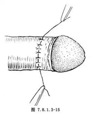 (4)缝合切口:创面彻底止血后,对合内外板切口缘,用常规方法行间断缝合