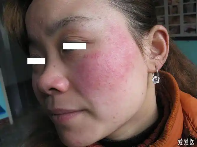 看图识病----------------------------面癣 - 皮肤及性传播疾病讨论