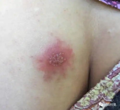 发生在臀部的疱疹叫做单纯疱疹,有的医生把发生在臀部以及外阴部位的