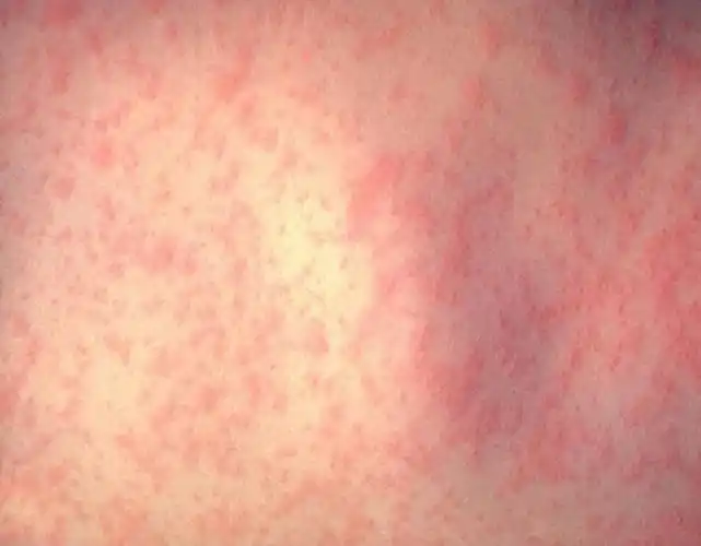 为啥发达国家也流行麻疹了?防控关键就是它!