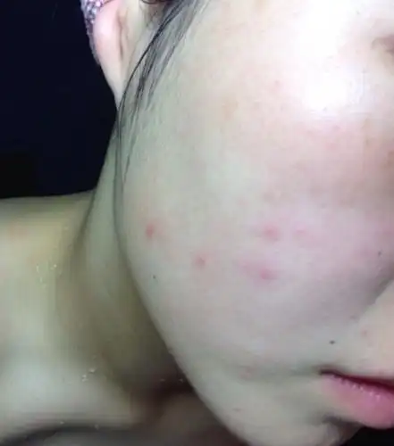 过敏还能用护肤品吗