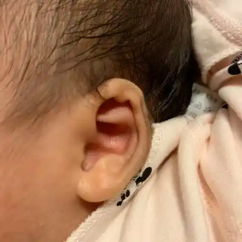 这种耳廓形态算畸形吗 会不会长正常呢 需要装矫正器吗