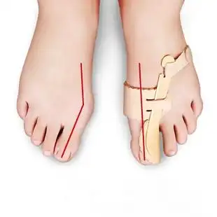 导致拇外翻的主要原因是什么?