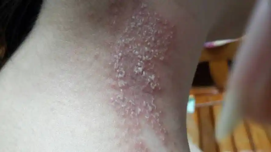 脖子上不知道怎么了,刚开始起水泡,现在这样子 , 都两天了,请问这是