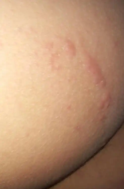 屁股长了东西,痒死了,请问这是什么,该怎么办