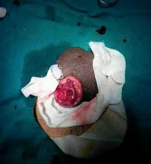 小男孩做包茎的图片