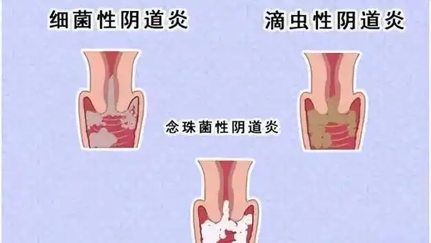 为什么月经结束后会出现褐色分泌物哪些分泌物要注意