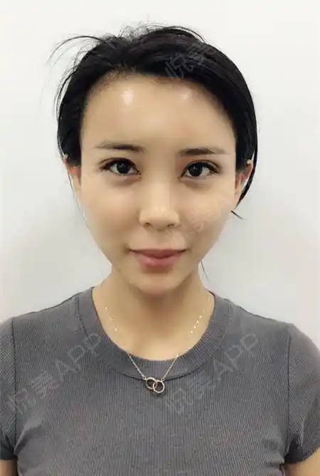 自体脂肪面部填充术后2天_自体脂肪丰太阳穴术后2天_自体脂肪丰额头术