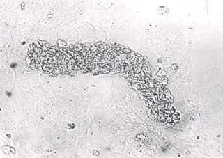 背景中可见较多的因染色而溶血的红细胞.