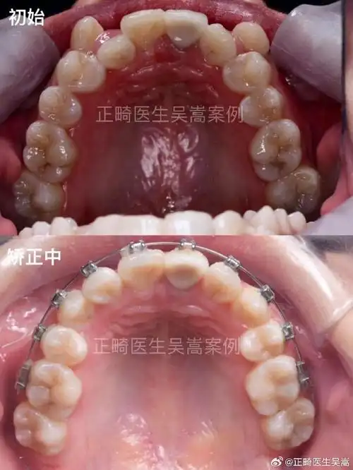 牙齿矫正##正畸##南京牙齿矫正