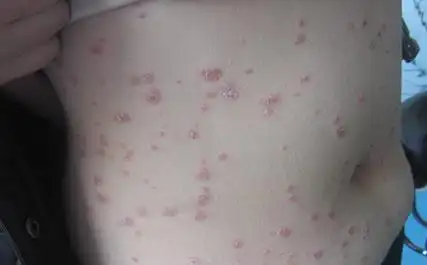 牛皮肤癣的几种种类类型及图片症状