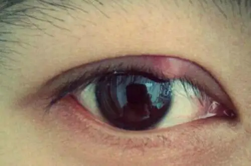 长针眼的症状图片35