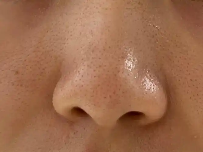 体验前变美诉求:鼻子及两侧毛孔粗大,有黑头.想要收缩毛孔.