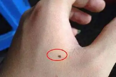 手上长痣怎么回事 女人右手长痣代表着什么