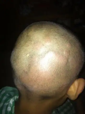 小孩头上突然长很多苞,又大又多.是怎么回事? 没有其他症状,偶尔会痒.