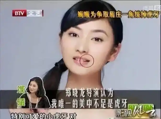 去口腔医院跑了十多次,最后还是把自己的虎牙拔掉了