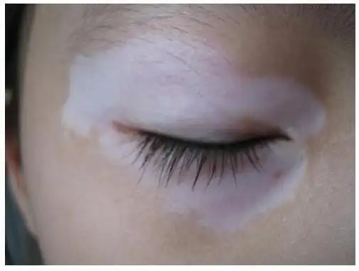 眼角有白斑怎么回事,怎么办?