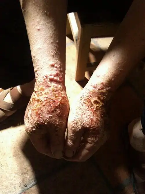 请问图片中的是湿疹吗,该怎么治疗.