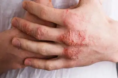 手背皮肤干燥开裂发红图片_妙手医生