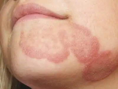 脸上长癣是什么原因. _春雨医生